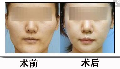 呼和浩特魚尾紋自體脂肪填充美容醫(yī)院口碑排名前10強，用戶口碑爆棚！