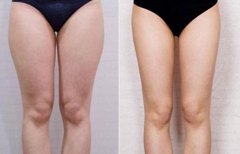 杭州哪家醫(yī)院治療疤痕效果好？推薦杭州修復(fù)疤痕的醫(yī)院專業(yè)醫(yī)美技術(shù)