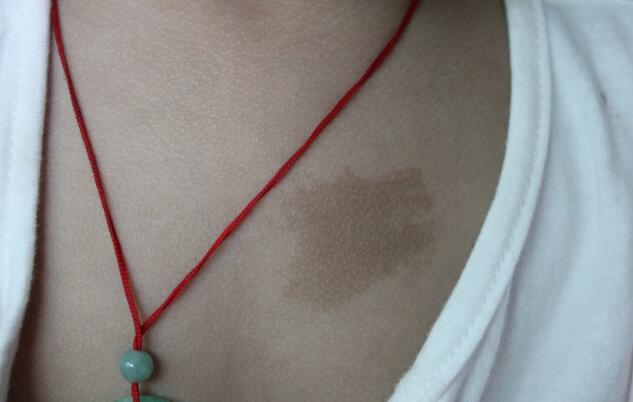 玻尿酸豐額頭為何造成凹凸不平？有效解決方法是什么？