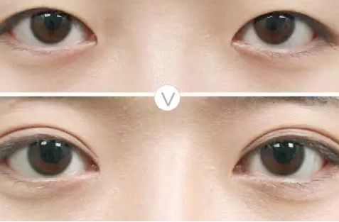 2023年巴蜀城市雙眼皮手術(shù)權(quán)威醫(yī)師推薦