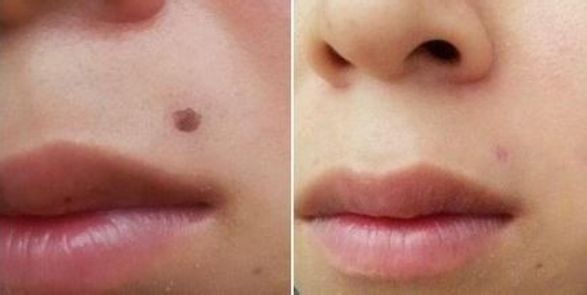 武漢哪家醫(yī)院專業(yè)從事線雕隆鼻手術(shù)效果好？