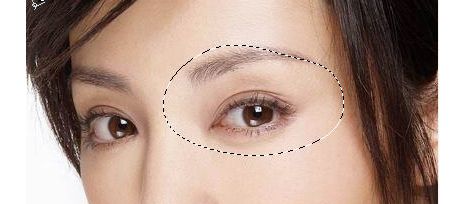 【醫(yī)院概況】北京侯俊杰醫(yī)生引領(lǐng)眼部整形潮流，真實過程圖分享！