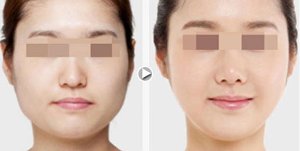 揭秘南京3D精微祛眼袋整形機(jī)構(gòu)實(shí)力榜單