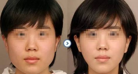 成都注射嗨體推薦排行榜出爐！Top10醫(yī)院盤點(diǎn)