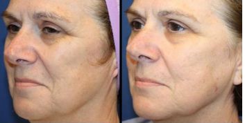 昆明玻尿酸填充眼周細(xì)紋，哪幾家醫(yī)院值得信賴？