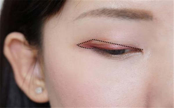 注射瘦腿的價格是由哪些因素影響的？