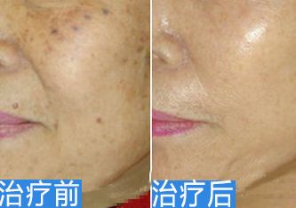 濟南做眼袋哪家醫(yī)院好？專家推薦濟南當?shù)仨敿壯鄞中g(shù)醫(yī)院