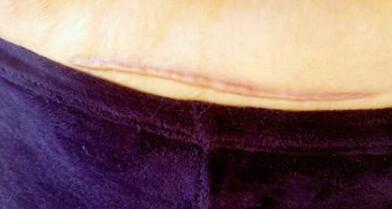 臉部削骨手術(shù)貴嗎？潮流的臉部削骨手術(shù)帶來了哪些改變