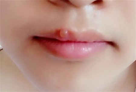 廣州哪家醫(yī)院的上眼瞼吸脂手術更出色？2023年廣州十家值得信賴的上眼瞼吸脂整形醫(yī)院推薦一覽！值得珍藏