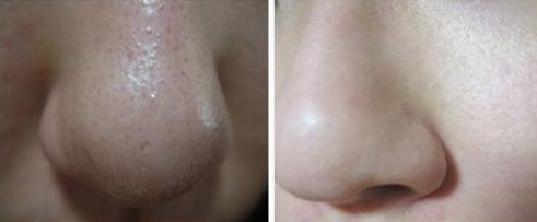 鄭州隆鼻手術哪家醫(yī)院好？選對醫(yī)院，打造完美鼻型！