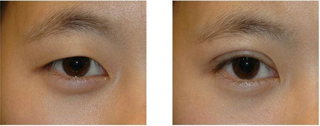 南京鼻翼寬治療醫(yī)院哪家好？專家?guī)湍闾暨x最佳鼻翼寬修復(fù)醫(yī)院