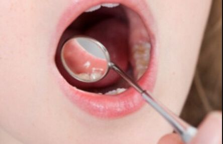 深圳祛痘印痘坑哪家醫(yī)院最靠譜？