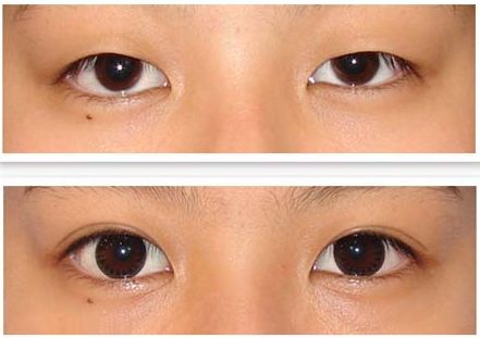 包頭哪家整形醫(yī)院做假體鼻子好？一起來搜一下！