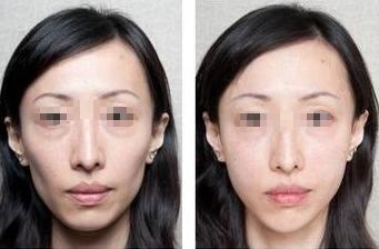 十堰眼瞼填充玻尿酸：專業(yè)機構(gòu)大揭秘