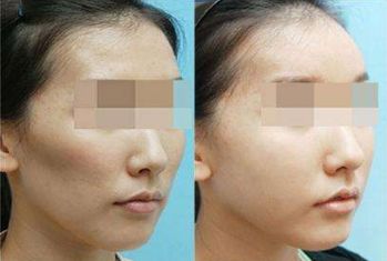 上?？s鼻翼整形醫(yī)院排行榜