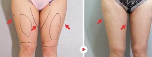 蒜頭鼻整形手術(shù)前后你需要了解的重要注意事項(xiàng)