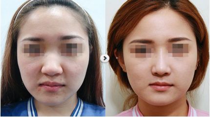 重慶華美整形醫(yī)院眼鼻整形美容：選擇李超醫(yī)生，完美塑造理想鼻型