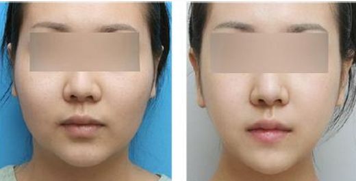 武漢剖腹產(chǎn)疤痕修復醫(yī)院排行榜：獲取最佳推薦