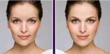 杭州自體脂肪填充隆鼻醫(yī)院十佳排行