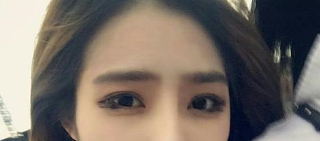 雙眼皮恢復需要多久？恢復受哪些因素影響？