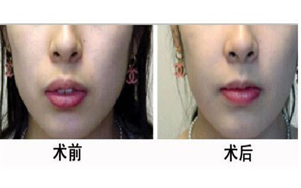 西美趙永政隆胸有哪些效果？整形術(shù)后能實(shí)現(xiàn)豐胸嗎？