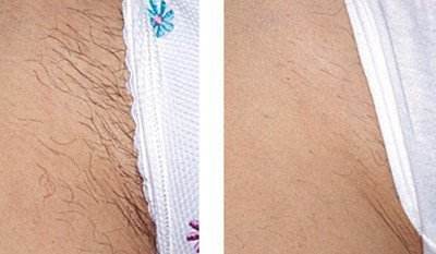 耳軟骨隆鼻有哪些優(yōu)點？優(yōu)缺總結(jié)分析