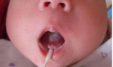 長春去胎記哪家醫(yī)院好？專家推薦的最佳醫(yī)院是哪家？