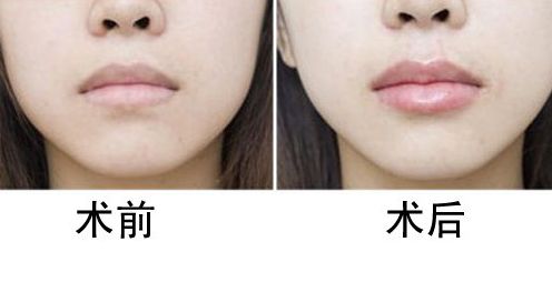 上海做雙眼皮，哪家醫(yī)院好？專業(yè)醫(yī)院推薦