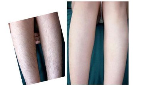 杭州激光祛痘醫(yī)院排名和費(fèi)用對比，哪家醫(yī)院激光祛痘好？