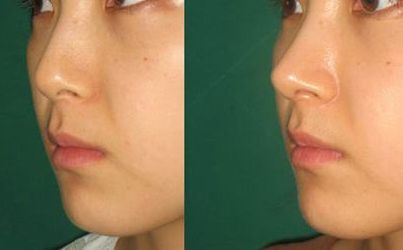 劉憲華整容傳聞揭秘：真相到底如何？