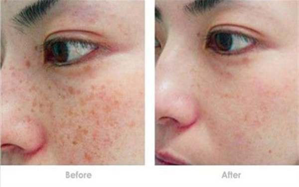 隆胸有哪些方式？效果能保持多久？需要注意哪些問(wèn)題？