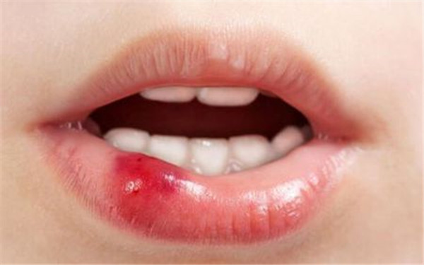 拉皮手術(shù)是什么？拉皮手術(shù)有哪些優(yōu)勢？