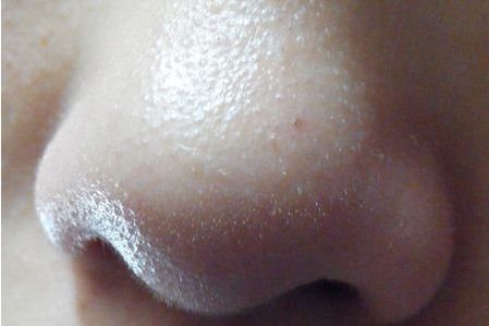 常州哪家醫(yī)院去眼袋效果好？眼袋怎么去除最有效？