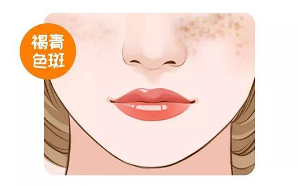 脖子注射玻尿酸如何定價(jià)？操作須注意什么？