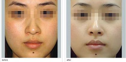 石家莊嗨體川字紋醫(yī)院口碑排行榜前十，你該如何選擇？