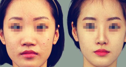 蘇州醫(yī)美去痘坑醫(yī)院權(quán)威推薦：十家口碑之選