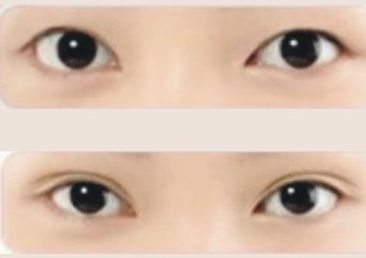 崔雪莉的眼睛整容傳聞：真相揭秘