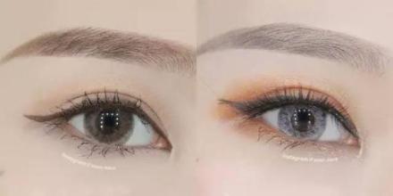 玻尿酸墊下巴可以在多久后恢復(fù)自然？了解玻尿酸是什么？玻尿酸墊下巴后會長期有效嗎？