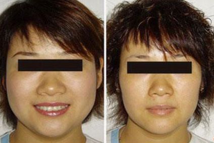 德州自體脂肪填充鼻部實力醫(yī)院排名榜單出爐，TOP10醫(yī)院震撼揭曉！