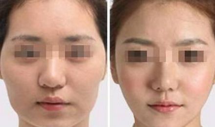 南京鼻部線雕修復(fù)排名前10整形美容醫(yī)院攻略！