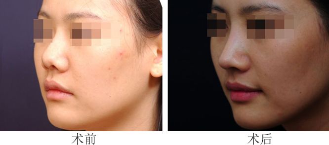 鼻子填充的方法和地點(diǎn)有哪些