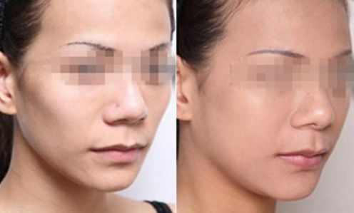 杭州膨體隆胸整形醫(yī)院排行榜top10大揭秘！