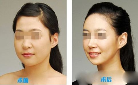 滕州水光針法令紋醫(yī)院排行榜TOP10，哪家專業(yè)又可信？