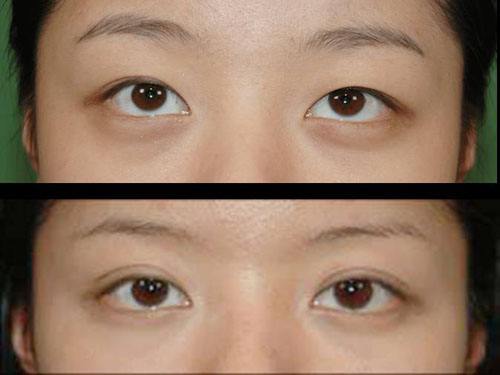 廣元哪家醫(yī)院去除川字紋的效果好？2023年很受歡迎的微創(chuàng)手術(shù)整形醫(yī)院排行榜