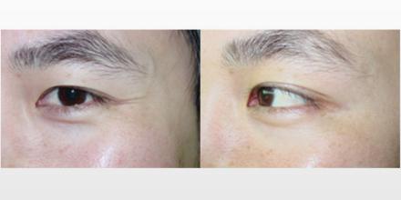 如何通過注射療法來瘦小腿？為什么要避開果酸注射瘦腿方法？