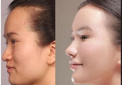 深圳注射溶脂針瘦手臂醫(yī)院排行榜前10大，口碑超贊！