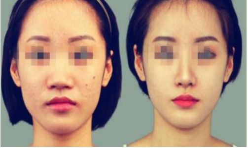 昆明眶隔脂肪釋放手術(shù)哪家醫(yī)院好？口碑評價揭秘！