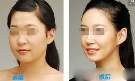 上海頸紋祛除哪家醫(yī)院口碑比較好？排行榜前十強推薦