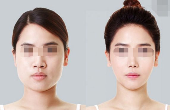 內(nèi)蒙古哪家醫(yī)院背部抽脂效果比較好？Top10強(qiáng)排名大揭秘!