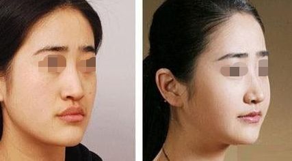 深圳面部溶脂美容醫(yī)院排行榜：告別雙下巴，打造精致小V臉